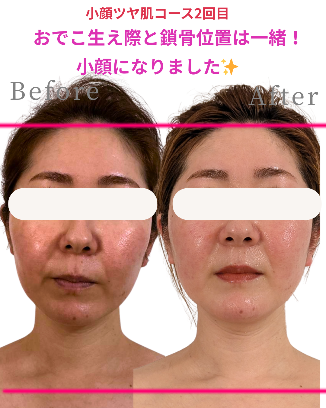 横浜鶴見/完全個室で叶える30代後半のたるみ改善フェイシャル