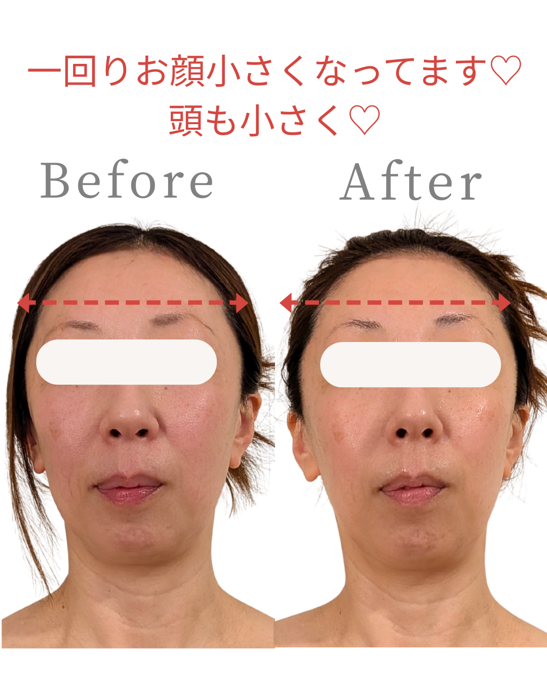 顔の乾燥はたるみの原因？30代からの保湿ケアが大切