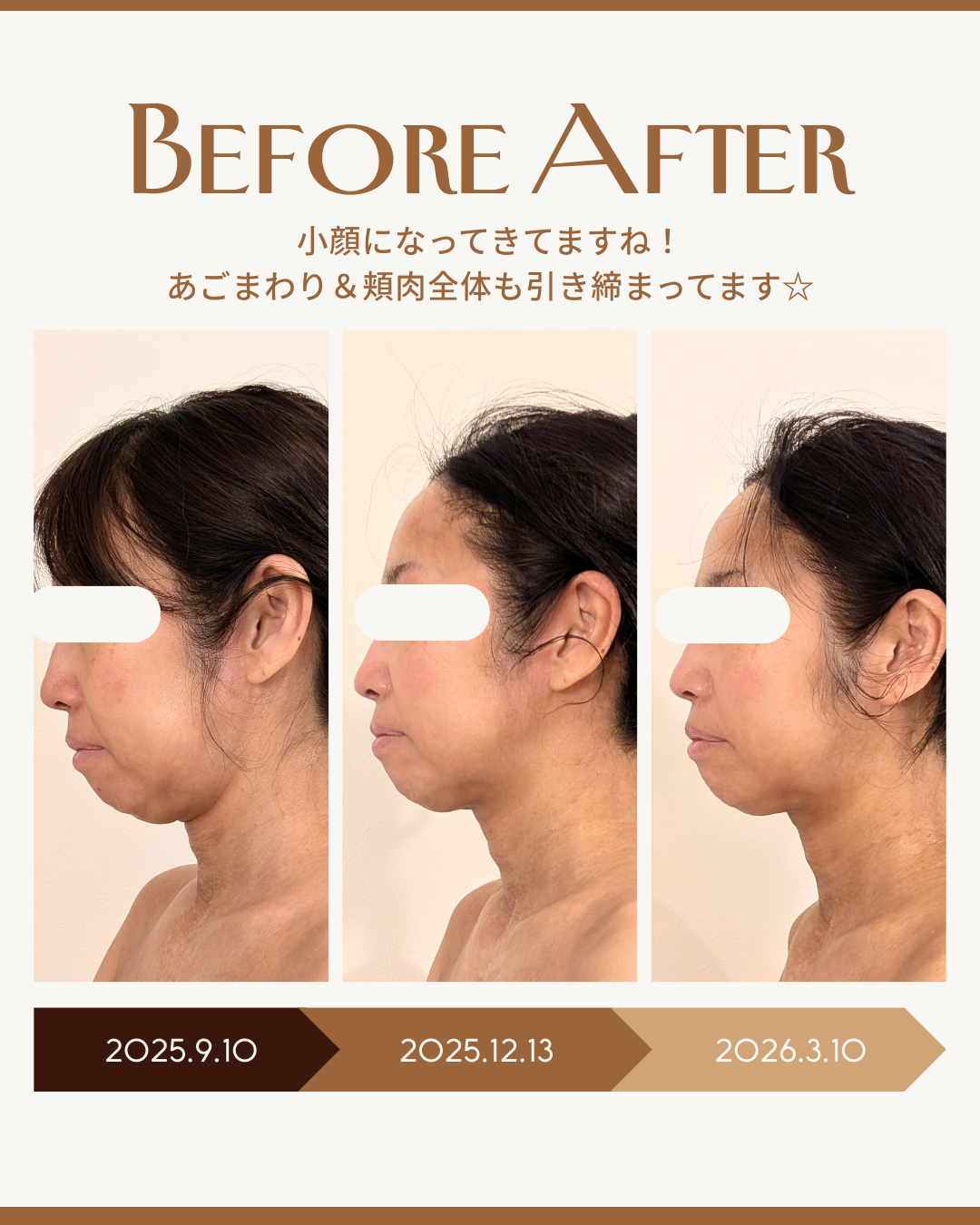 半年でたるみ激変。40代からの小顔ケア