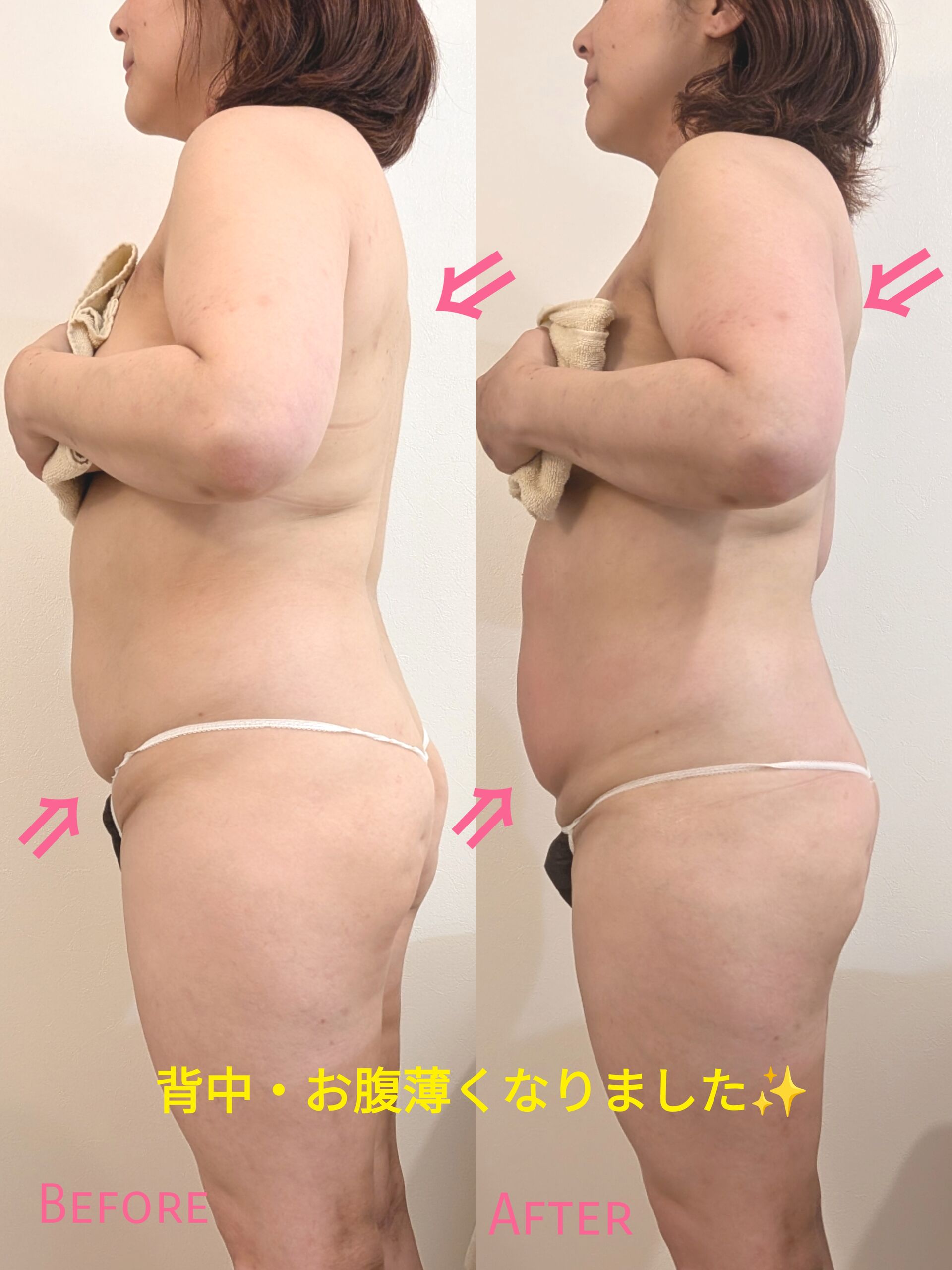 40代・50代【お腹痩せ】世界初のMFR技術で、年齢とともに諦めていた「厚いお腹」をスッキリ解消