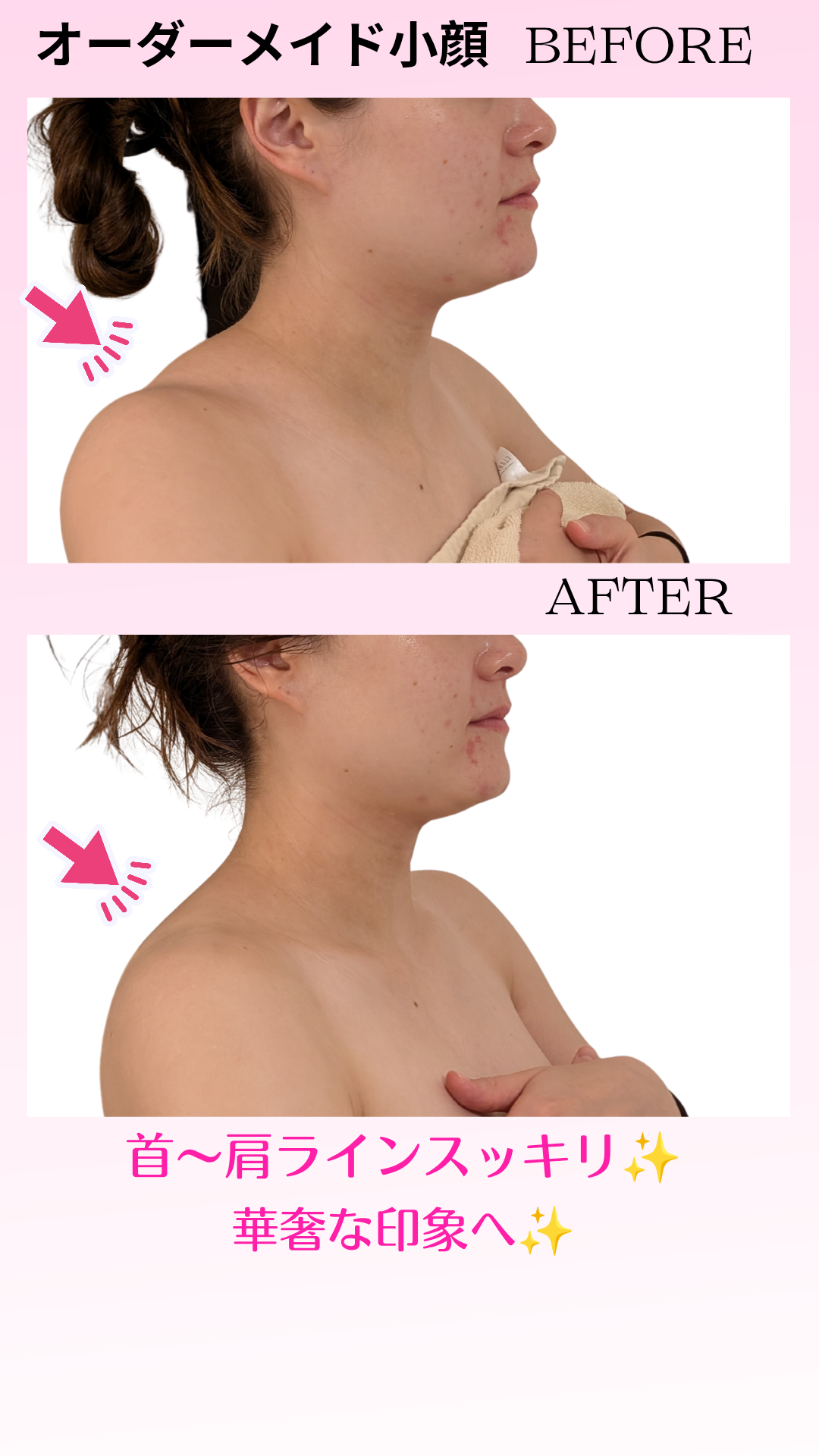 小顔になり、さらに、首〜肩まで華奢な印象へ◎